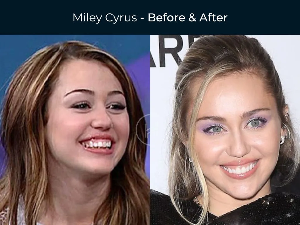 Celebrities with Gum Recession