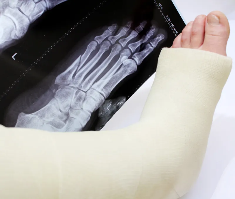 Casted foot with X-ray film showing broken bones.